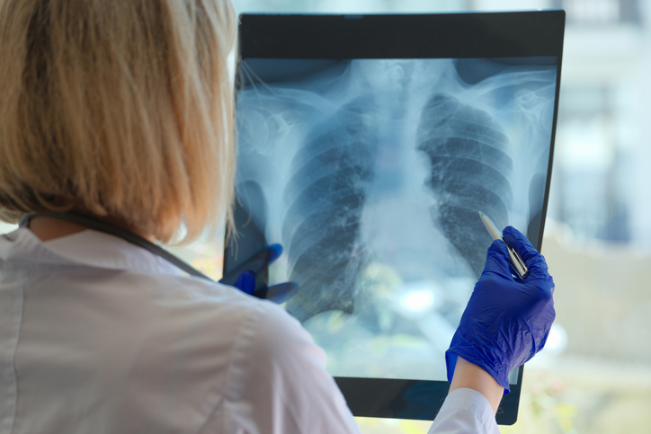 Ärztin von Hinten bei der Lungenkrebsvorsorge als Neuerung ab April 2026. Sie hält eine CT-Aufnahme der Lunge und einen Stift in den Händen und trägt blaue Handschuhe.